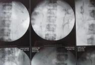 男子体内长四个肾 可以买肾6了
