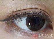 儿童眼球不自主运动诊断多动症