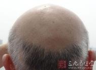 远离脱发 男人应做持久战