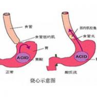 胃酸怎么办