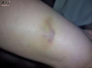 淤青怎么快速消除