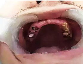 19岁少年牙齿全烂掉 盘点牙齿全烂掉的原因