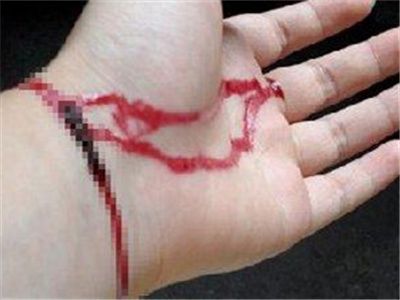 割腕自杀怎么急救