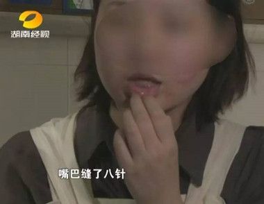 女子飙车撞破相缝八针 飙车有什么危害