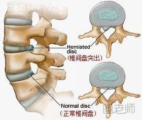 腰椎间盘突出症自我疗法