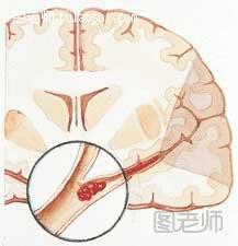 脑梗塞的护理方法