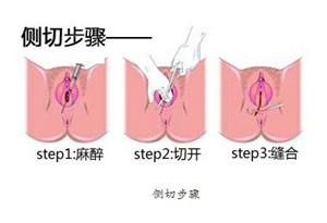 什么是顺产侧切