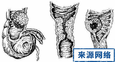 隆胸手术术前术后的常识|晚上睡觉打呼噜怎么