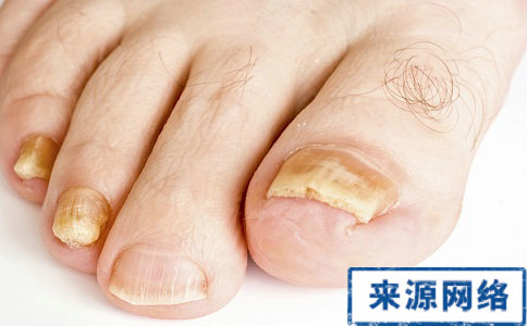 初夏脚气来袭 推荐治疗脚气偏方|脚气怎么治疗