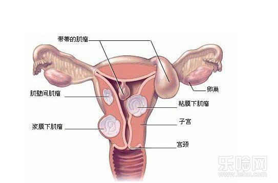 子宫肌瘤