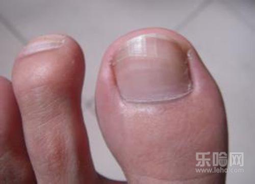 脚趾甲有横纹凹凸不平怎么回事
