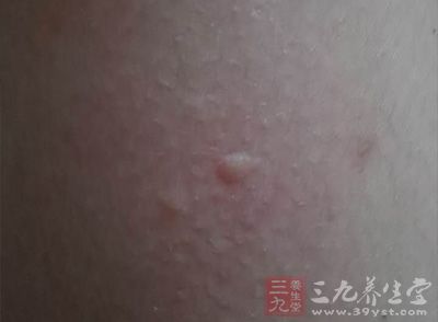 衣原体感染刚开始的一段时间症状为水泡