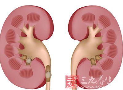 肾癌也叫做肾细胞癌、肾腺癌