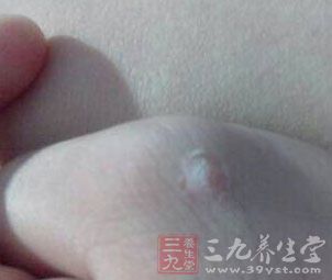 如果手上长藓了，不仅不美观，还会觉得瘙痒