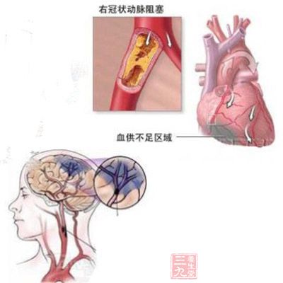 常吃生花生可以降低胆固醇防止心血管疾病