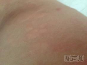 身上起疙瘩很痒怎么办