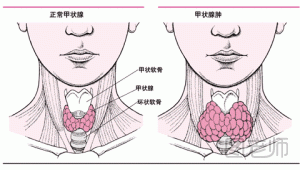 甲状腺结节需手术吗