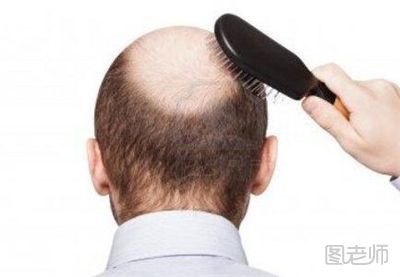 脱发怎么办_男性怎么预防脱发