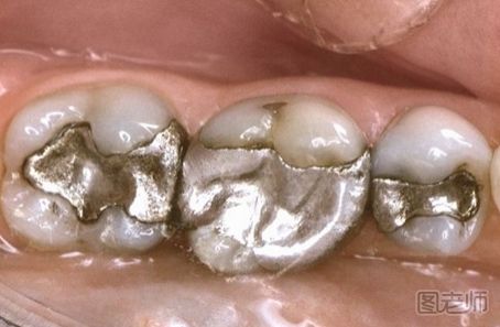 补牙洞用什么材料最好?补牙洞最合适的材料