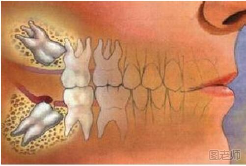 拔智齿有什么危害 拔智齿有什么后遗症