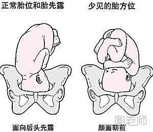 怎样发现胎位异常 胎位异常的危险