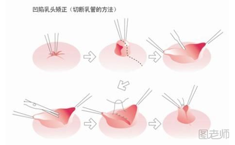 乳头内陷的症状