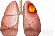 肺癌确诊需要做什么检查