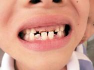 孩子牙齿矫正的最佳年龄是多少?
