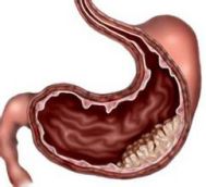 胃癌的症状有哪些 胃癌有什么症状
