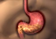 胃癌症状的早期表现 胃癌的早期症状是什么