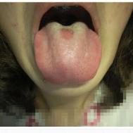 舌头正中舌苔脱落的原因