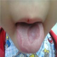 舌头溃疡应该怎么办呢？