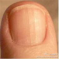 手指甲脆是什么原因