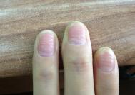 如何预防手指甲凹凸不平？手指甲凹凸不平的危害
