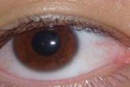 眼睛有红血丝是什么原因