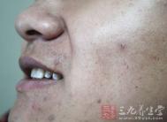 美容护肤 男人祛痘的正确方法