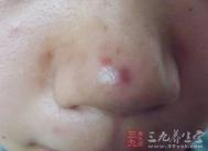 鼻翼长痘的原因 消除鼻翼上的痘痘