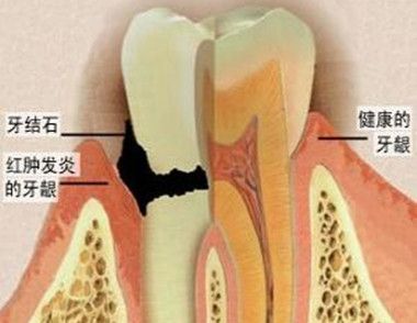 牙结石怎么去除 牙结石怎么去除