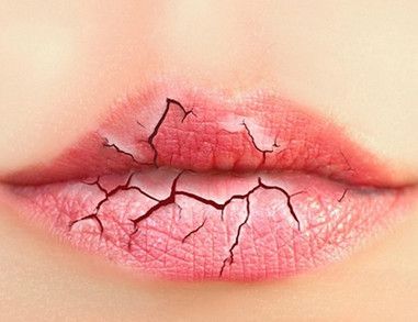嘴唇干裂的原因是什么 什么原因导致嘴唇干裂