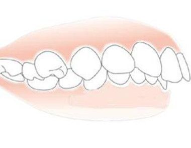 牙暴突出如何治疗 牙暴突出的治疗方法
