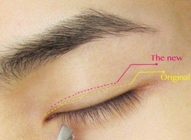 什么是双眼皮埋线？埋线双眼皮能保持多久