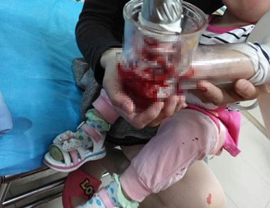 长沙2岁女孩被手被榨汁机搅伤 使用榨汁机时要注意什么