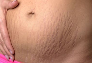 妈妈的妊娠纹有点影响美观 如何去除妊娠纹