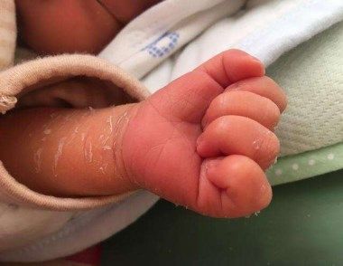 新生儿脱皮是是什么原因导致的 新生儿脱皮该如何护理