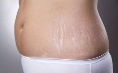 妊娠纹是怎样产生的 预防妊娠纹产生的方法 产后妊娠纹如何消除