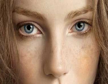 眼角长斑是什么原因引起的？  眼角长斑怎么办？