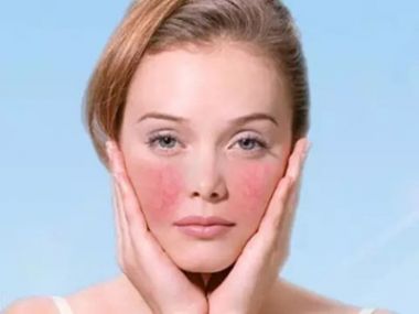 激素脸日常要怎么护肤？