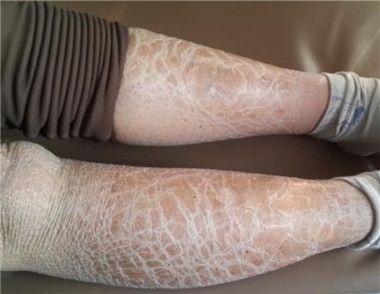 冬季小腿干燥脱皮怎么办？小腿总是脱皮是病吗？