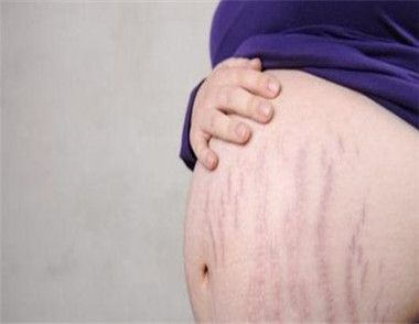 妊娠纹是什么 妊娠纹该怎么消除