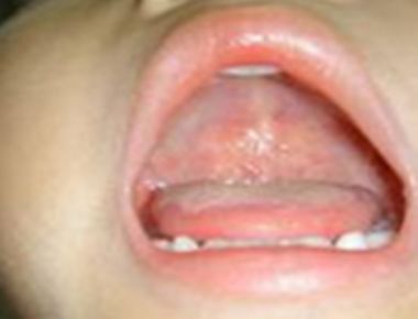 宝宝疱疹咽峡炎 疱疹咽峡炎临床表现